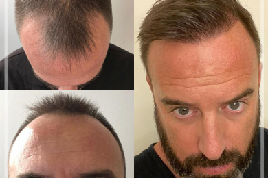 Hair Transplant 1