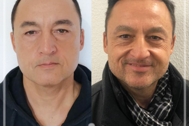 Hair Transplant 2