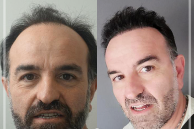 Hair Transplant 3
