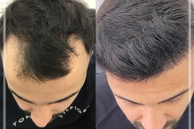 Hair Transplant 5