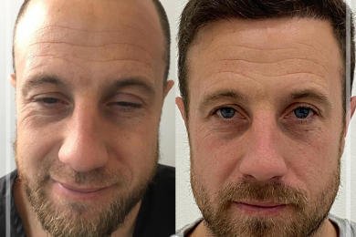 Hair Transplant 6