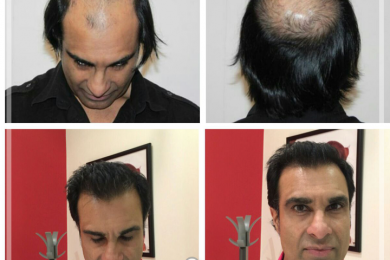 Hair Tansplant 7