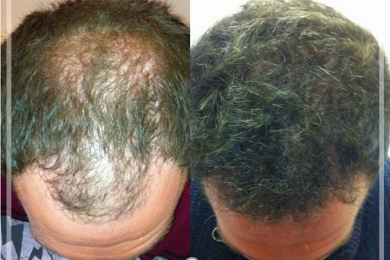 Hair Transplant 8