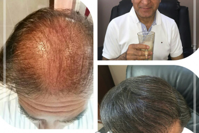 Hair Transplant 9