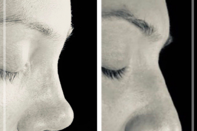 Rhinoplasty 1