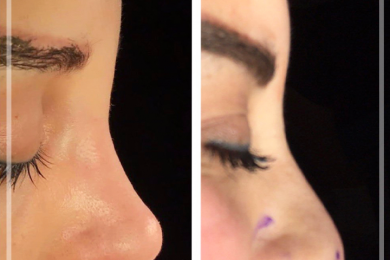 Rhinoplasty 2
