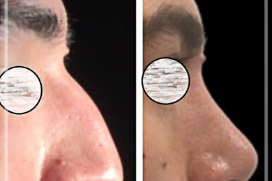 Rhinoplasty 3