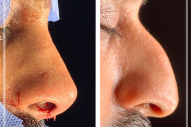 Rhinoplasty 4