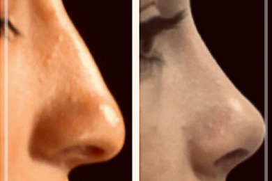 Rhinoplasty 5