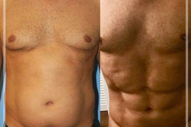 Six-Pack Operation